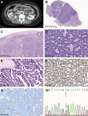Atypical metanephric adenoma: Shares similar histopathological features and molecular changes of metanephric adenoma and epithelial-predominant Wilms’ tumor